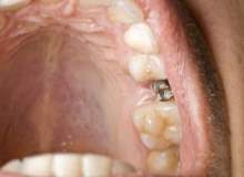 Diş implantları kaç yıl kullanılır?