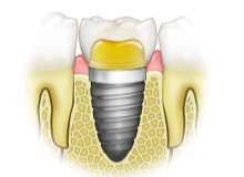Diş implantlarında yan etki görülür mü?