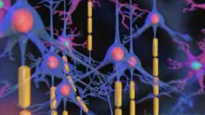 Parsiyel Epilepsi Nöbeti