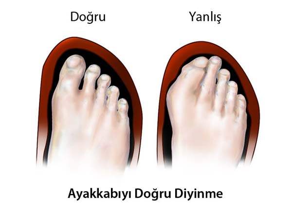 Tırnak Mantarı İçin Ayakkabı Seçimi Nasıl Olmalıdır?