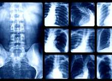 Dünya KOAH Günü Dünya KOAH Günü