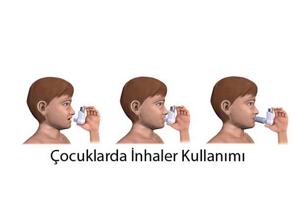 Astım çocuğunuzun yaşamını kısıtlamasın