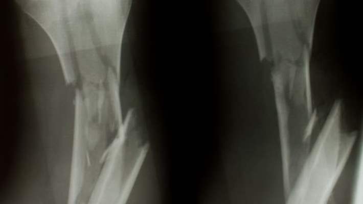 Ayak Kırığı Tedavisi