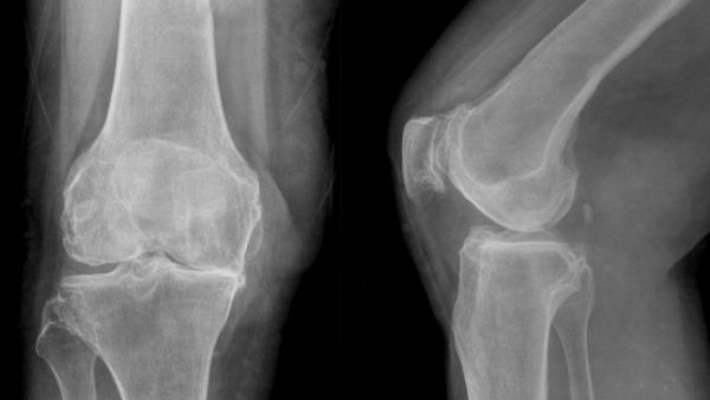 Bacak Kırığı Tedavisi