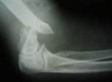 Dirsek Kırığı Tedavisi Dirsek Kırığı Tedavisi