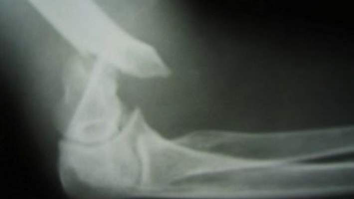 Dirsek Kırığı Tedavisi