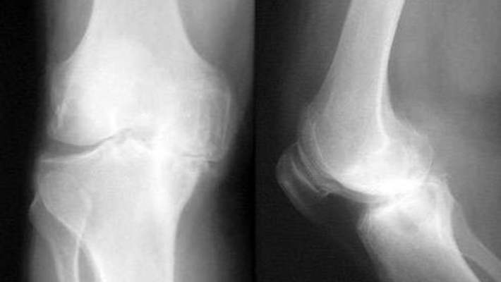 Diz Çıkığı Tedavisi