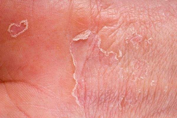 Kontakt Dermatit (Alerjik Egzama) Tedavisi