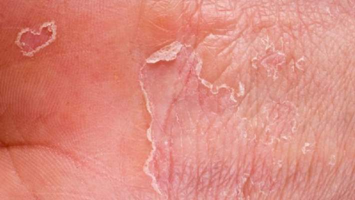 Kontakt Dermatit (Alerjik Egzama) Tedavisi