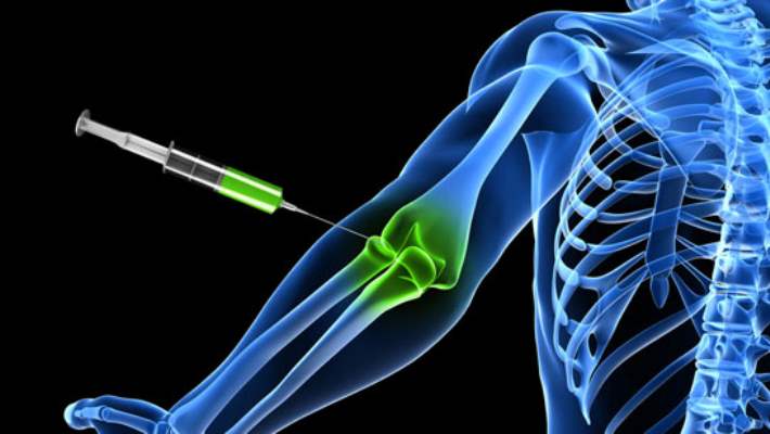 Mukoza Kesecik İltihabı (Bursit) Tedavisi