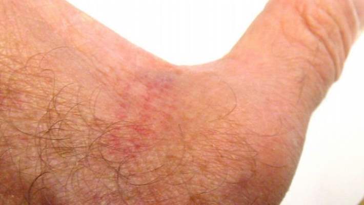 Maya Enfeksiyonu Ve Deri Döküntüsü Tedavisi