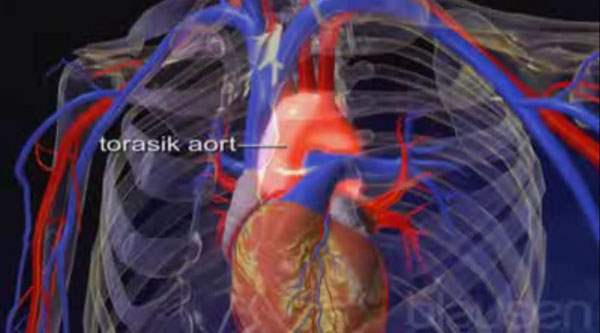 Aort Kapak Darlığı
