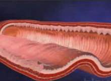 Bağırsak İskemisi ve Enfarktüsü Bağırsak İskemisi ve Enfarktüsü