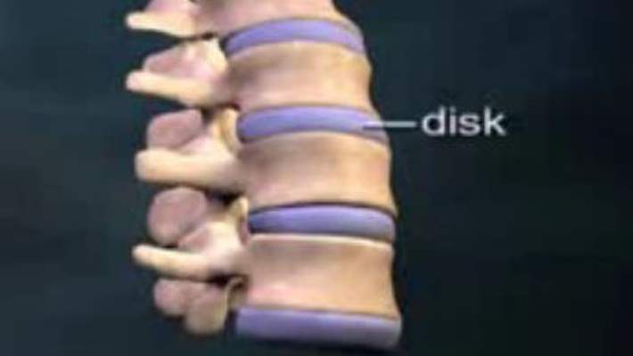 Disk Kayması Tedavisi