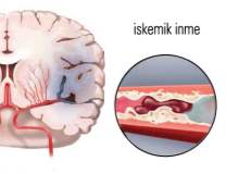 Geçici İskemik Atak Geçici İskemik Atak