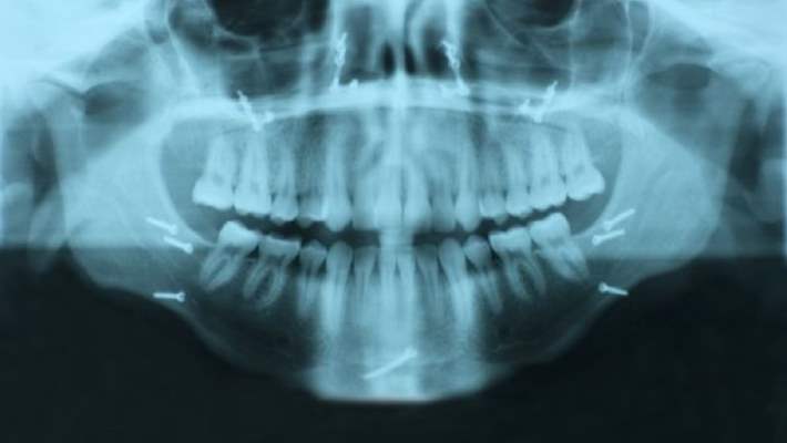 Yüz Bölgesi Kırıkları