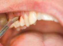 Diş Eti Hastalığı
