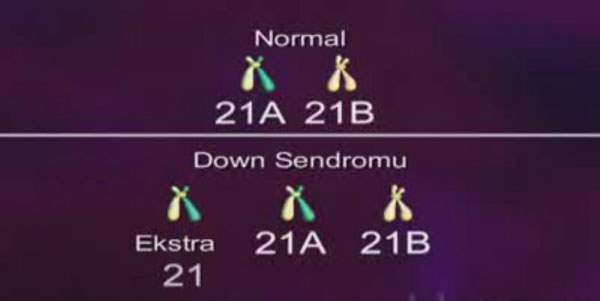 Down Sendromu