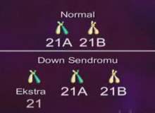 Down Sendromu