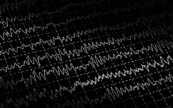 Epilepsi (Tonik Klonik Veya Büyük Nöbet Epilepsi)