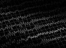 Epilepsi (Tonik Klonik Veya Büyük Nöbet Epilepsi) Epilepsi (Tonik Klonik Veya Büyük Nöbet Epilepsi)
