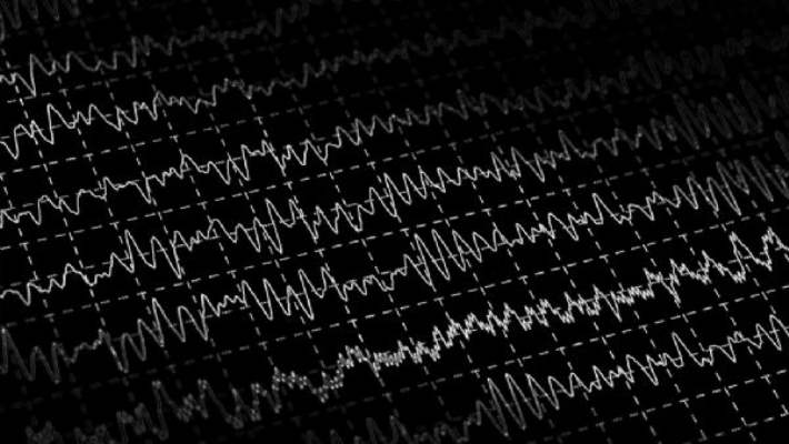 Epilepsi (Tonik Klonik Veya Büyük Nöbet Epilepsi)