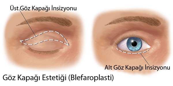 Gevşek Gözkapağı Sendromu