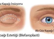 Gevşek Gözkapağı Sendromu Gevşek Gözkapağı Sendromu