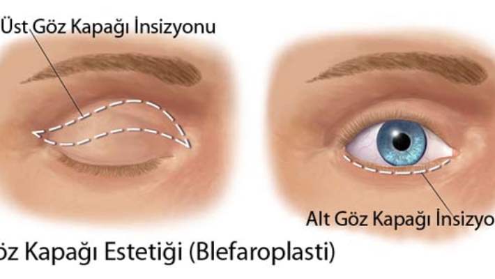 Gevşek Gözkapağı Sendromu