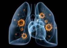 Bakteriyel Akciğer Enfeksiyonu Bakteriyel Akciğer Enfeksiyonu