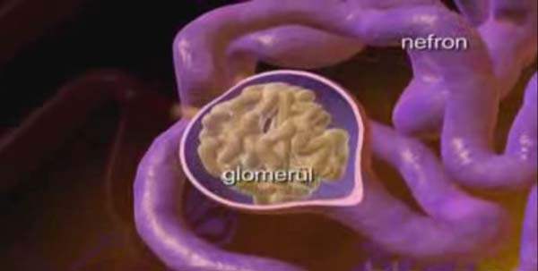 Glomerülonefrit