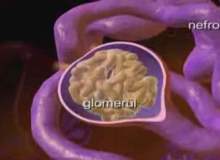 Glomerülonefrit Glomerülonefrit
