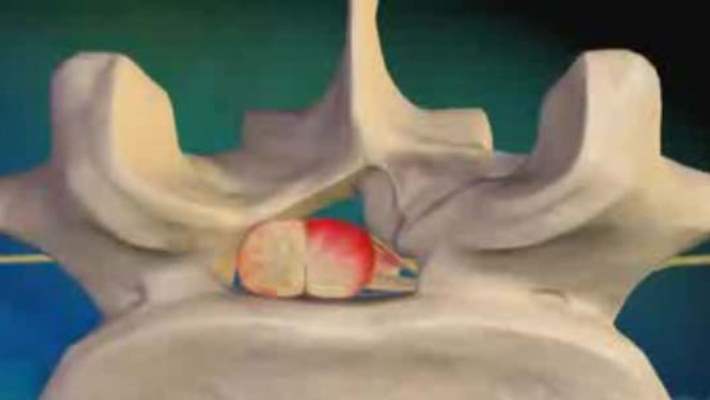 Göğüs (Torasik) Omurgası Stenozu