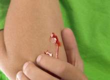 Hemofili Hemofili