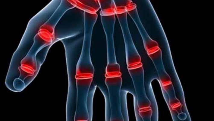 Karpal Tünel Sendromu