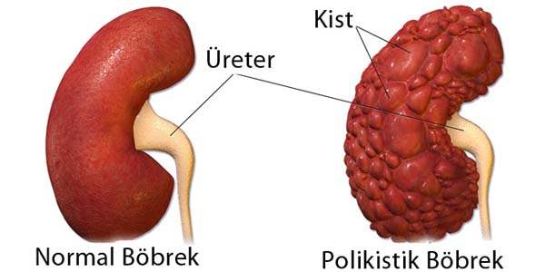 Polikistik Böbrek Hastalığı