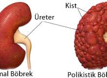 Polikistik Böbrek Hastalığı Polikistik Böbrek Hastalığı