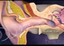 Kulak Zarı Yırtılması Kulak Zarı Yırtılması