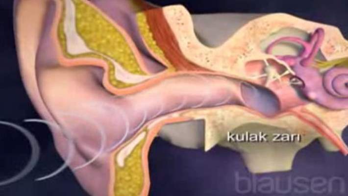 kulak zari yirtilmasi hemen saglik