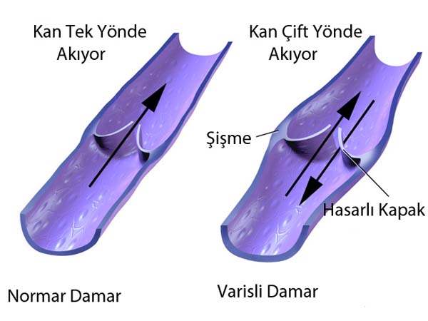 Varisli Toplar Damarlar