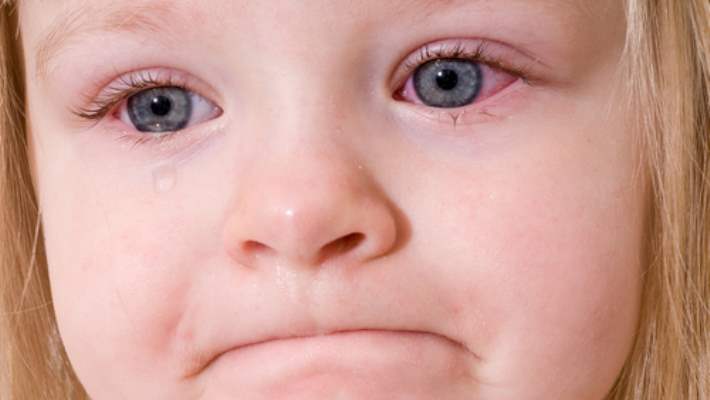 Göz Yangısı (Konjunktivit): Sebepleri, Belirtileri Ve Tedavileri
