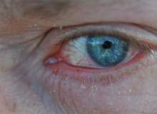Kuru Göz Sendromu