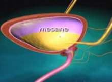 Mesane Çıkışında Tıkanma Mesane Çıkışında Tıkanma