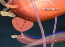 Mesane Taşları Mesane Taşları