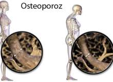 Osteoporoz (Kemik Erimesi) Osteoporoz (Kemik Erimesi)