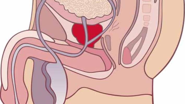 Prostat Bezi Büyümesi