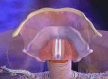 Ses Teli Nodülleri ve Polipleri Ses Teli Nodülleri ve Polipleri