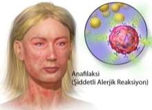 Anaflaksi (Şiddetli Alerjik Reaksiyon) Anaflaksi (Şiddetli Alerjik Reaksiyon)