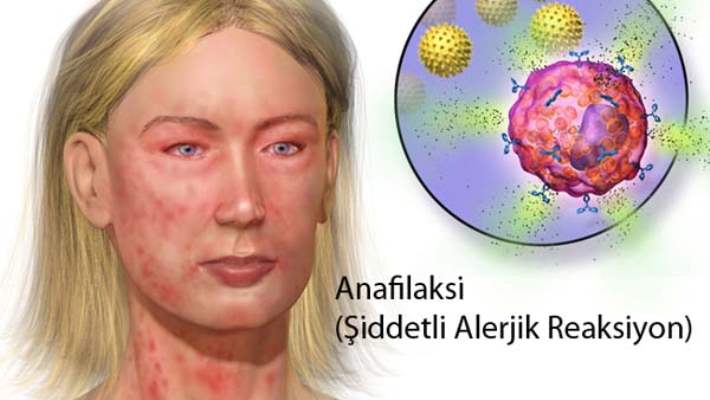Anaflaksi (Şiddetli Alerjik Reaksiyon)