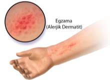 Dermatit  (Deri İltihabı) Dermatit  (Deri İltihabı)